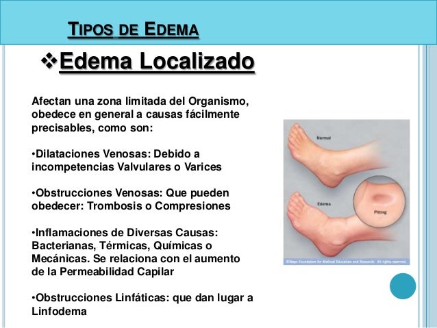 Edema expo