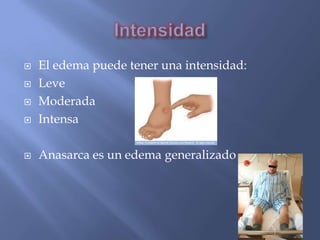    El edema puede tener una intensidad:
   Leve
   Moderada
   Intensa

   Anasarca es un edema generalizado
 