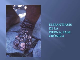 ELEFANTIASIS
DE LA
PIERNA, FASE
CRÓNICA
 