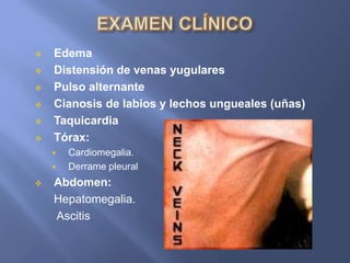    Edema
   Distensión de venas yugulares
   Pulso alternante
   Cianosis de labios y lechos ungueales (uñas)
   Taquicardia
   Tórax:
       Cardiomegalia.
       Derrame pleural
   Abdomen:
    Hepatomegalia.
    Ascitis
 
