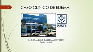 CASO CLINICO DE EDEMA38
H. G. DR. AQUILES CALLES RAMIREZ “ISSSTE”
Tepic, Nayarit.
 