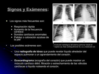 Signos y Exámenes : Los signos más frecuentes son: Respiración rápida  Aumento de la frecuencia cardiaca Sonidos cardíacos anormales Palidez o coloración azulosa de la piel Los posibles exámenes son: Una  radiografía de tórax  que puede revelar líquido alrededor del  espacio pulmonar o un agrandamiento del corazón. Ecocardiograma  (ecografía del corazón) que puede mostrar un  músculo cardíaco débil, filtración o estrechamiento de las válvulas  cardíacas o líquido rodeando el corazón. Evolución radiológica del edema pulmonar desde el ingreso (a), fase cardiopulmonar (b y c) y resolución (d) 