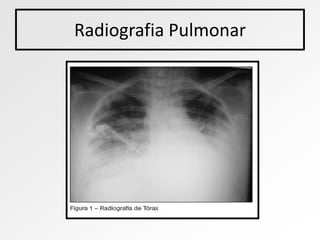 Radiografia Pulmonar
 