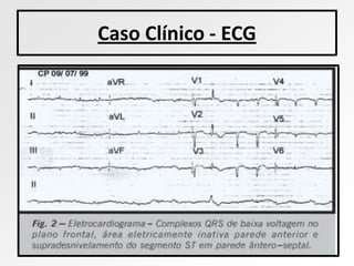 Caso Clínico - ECG
 