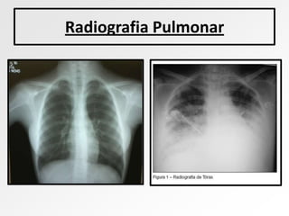 Radiografia Pulmonar
 