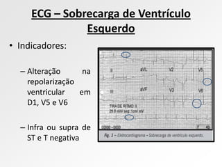 ECG – Sobrecarga de Ventrículo
               Esquerdo
• Indicadores:

  – Alteração      na
    repolarização
    ventricular   em
    D1, V5 e V6

  – Infra ou supra de
    ST e T negativa
 