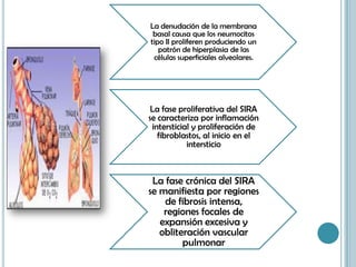 La denudación de la membrana
basal causa que los neumocitos
tipo II proliferen produciendo un
patrón de hiperplasia de las
células superficiales alveolares.
La fase proliferativa del SIRA
se caracteriza por inflamación
intersticial y proliferación de
fibroblastos, al inicio en el
intersticio
La fase crónica del SIRA
se manifiesta por regiones
de fibrosis intensa,
regiones focales de
expansión excesiva y
obliteración vascular
pulmonar
 