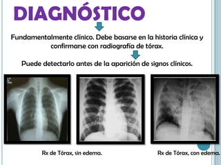 DIAGNÓSTICO
Fundamentalmente clínico. Debe basarse en la historia clínica y
confirmarse con radiografía de tórax.
Puede detectarlo antes de la aparición de signos clínicos.
Rx de Tórax, sin edema. Rx de Tórax, con edema.
 