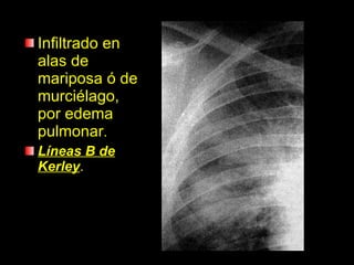 Infiltrado en alas de mariposa ó de murciélago, por edema pulmonar . Líneas B de Kerley . 