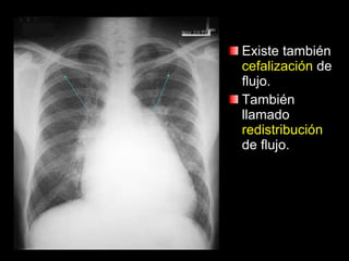 Existe también  cefalización  de flujo. También llamado  redistribución  de flujo. 