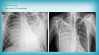 Otras Técnicas
Resonancia Magnética
 