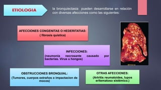 la bronquiectasia pueden desarrollarse en relación
con diversas afecciones como las siguientes:
AFECCIONES CONGENITAS O HEDERITATIAS:
( fibrosis quística)
INFECCIONES:
(neumonía necrosante causado por
bacterias. Virus u hongos)
OBSTRUCCIONES BRONQUIAL:
(Tumores, cuerpos extraños o impactacion de
mocos)
OTRAS AFECCIONES:
(Artritis reumatoides, lupos
eritematoso sistémico.)
 