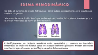Se debe al aumento de presión hidrostática , como sucede principalmente en la insuficiencia
cardiaca congestiva.
La acumulación de liquido tiene lugar en las regiones basales de los lóbulos inferiores ya que
la presión hidrostatica es mayor en dicho territorios.
Histológicamente los capilares alveolares están ingurgitados y aparece un tranxudado
intraalveolar de modo de material pálido de aspecto finamente granulado. Pueden observarse
microhemorragias alveolares y macrófagos cargados de hemosiderina .
 