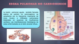 La lesión pulmonar aguda , también llamada
edema de pulmón no carcinogénico se
caracteriza por la hipoxemia importante de
inicio brusco e infiltrados pulmonares
bilaterales en ausencia de insuficiencia
cardiaca. Las manifestaciones histológicas de
estas enfermedades es el daño alveolar difuso.
 
