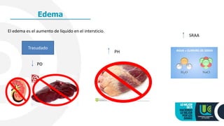 Edema
El edema es el aumento de líquido en el intersticio.
Trasudado
PO
PH
SRAA
 