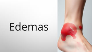 FISIOPATOLOGIA DEL EDEMA - PRINCIPIOS BASICOS | PPTX