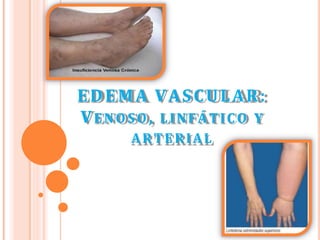 EDEMA VASCULAR:
VENOSO, LINFÁTICO Y
ARTERIAL
 