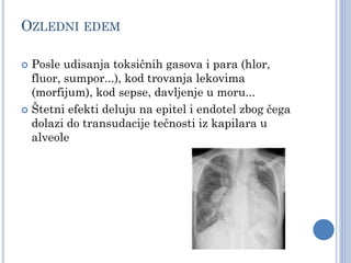 OZLEDNI EDEM
 Posle udisanja toksičnih gasova i para (hlor,
fluor, sumpor...), kod trovanja lekovima
(morfijum), kod sepse, davljenje u moru...
 Štetni efekti deluju na epitel i endotel zbog čega
dolazi do transudacije tečnosti iz kapilara u
alveole
 