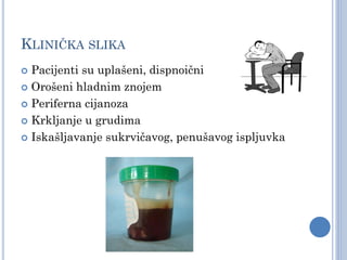 KLINIČKA SLIKA
 Pacijenti su uplašeni, dispnoični
 Orošeni hladnim znojem
 Periferna cijanoza
 Krkljanje u grudima
 Iskašljavanje sukrvičavog, penušavog ispljuvka
 