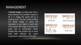 Edentulism | PPT