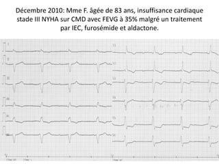 Décembre 2010: Mme F. âgée de 83 ans, insuffisance cardiaque
stade III NYHA sur CMD avec FEVG à 35% malgré un traitement
par IEC, furosémide et aldactone.
 