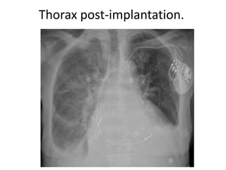 Thorax post-implantation.
 