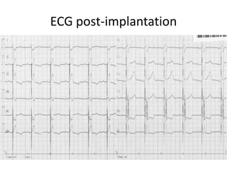 ECG post-implantation
 