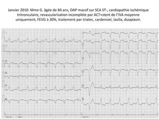 Janvier 2010: Mme G. âgée de 84 ans, OAP massif sur SCA ST-, cardiopathie ischémique
tritronculaire, revascularisation incomplète par ACT+stent de l’IVA moyenne
uniquement, FEVG à 30%, traitement par triatec, cardensiel, lasilix, duoplavin.
 