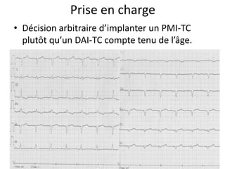 Prise en charge
• Décision arbitraire d’implanter un PMI-TC
plutôt qu’un DAI-TC compte tenu de l’âge.
 
