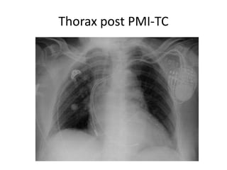 Thorax post PMI-TC
 