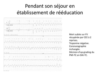 Pendant son séjour en
établissement de rééducation
Mort subite sur FV
récupérée par CEE à 2
reprises.
Troponine négative.
Coronarographie
inchangée.
Décision d’up-grading du
PMI-TC en DAI-TC.
 