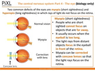 The central nervous system Part 4 - The eye (biology only)
Two common defects of the eyes are myopia (short sightedness) and
hyperopia (long sightedness) in which rays of light do not focus on the retina.
Myopia (short sightedness)
• People who are short
sighted cannot focus on
objects that are far away.
• It usually occurs when the
eyeball is too long.
• The light rays from distant
objects focus in the eyeball
in front of the retina.
• Myopia can be corrected
with concave lenses so that
the light rays focus on the
retina.
Concave lens
 