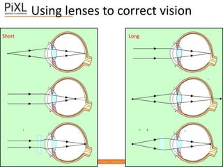 Using lenses to correct vision
Short Long
 