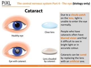 The central nervous system Part 4 - The eye (biology only)
Due to a cloudy patch
on the lens, light is
unable to enter the eye
normally.
People who have
cataracts often have
blurred vision and find
it difficult to see in
bright light or in
accurate colour.
Cataracts can be cured
by replacing the lens
with an artificial one.
 