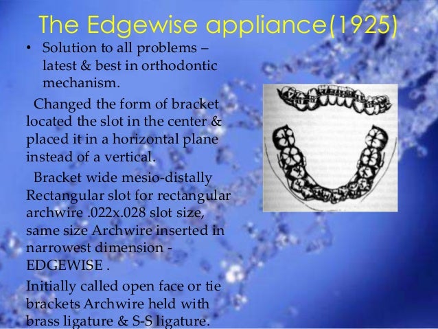 history and evolution of edgewise appliance edgewise appliance