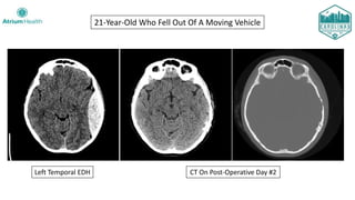 21-Year-Old Who Fell Out Of A Moving Vehicle
Left Temporal EDH CT On Post-Operative Day #2
 