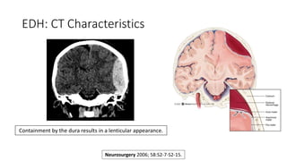 EDH: CT Characteristics
Containment by the dura results in a lenticular appearance.
Neurosurgery 2006; 58:S2-7-S2-15.
 