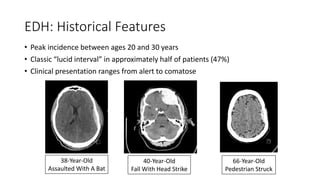 EDH: Historical Features
• Peak incidence between ages 20 and 30 years
• Classic “lucid interval” in approximately half of patients (47%)
• Clinical presentation ranges from alert to comatose
38-Year-Old
Assaulted With A Bat
40-Year-Old
Fall With Head Strike
66-Year-Old
Pedestrian Struck
 