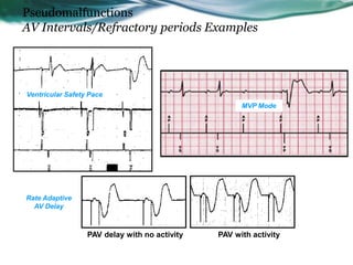Pseudomalfunctions
AV Intervals/Refractory periods Examples
Ventricular Safety Pace
MVP Mode
PAV delay with no activity PAV with activity
Rate Adaptive
AV Delay
 