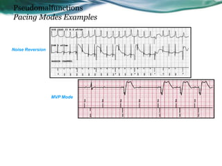 Pseudomalfunctions
Pacing Modes Examples
Noise Reversion
MVP Mode
 