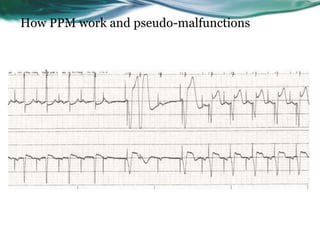 How PPM work and pseudo-malfunctions
 