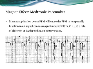 Magnet Effect: Medtronic Pacemaker
• Magnet application over a PPM will cause the PPM to temporarily
function in an asynchronous magnet mode (DOO or VOO) at a rate
of either 85 or 65 depending on battery status.
 