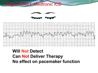 Will Not Detect
Can Not Deliver Therapy
No effect on pacemaker function
Magnet Effect: Medtronic ICD
 