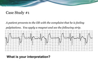 Case Study #1
A patient presents to the ER with the complaint that he is feeling
palpitations. You apply a magnet and see the following strip.
What is your interpretation?
 