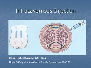 Intracavernous Injection
Roger S.Kirby et al.An Atlas of Erectile Dysfunction, 2005;78
Caverject® Dosage 2.5 - 5μg
 