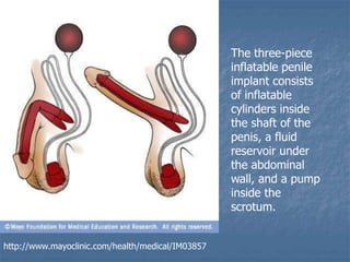 The three-piece
inflatable penile
implant consists
of inflatable
cylinders inside
the shaft of the
penis, a fluid
reservoir under
the abdominal
wall, and a pump
inside the
scrotum.
http://www.mayoclinic.com/health/medical/IM03857
 