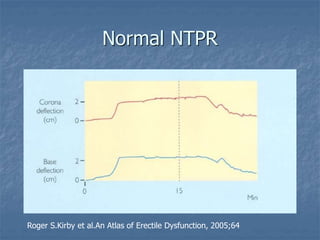 Normal NTPR
Roger S.Kirby et al.An Atlas of Erectile Dysfunction, 2005;64
 