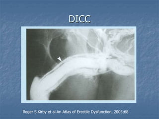 DICC
Roger S.Kirby et al.An Atlas of Erectile Dysfunction, 2005;68
 