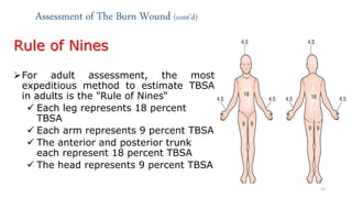 Tbsa Graph Classification, Principles, assessment and management of burn | PPTX