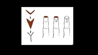 Reconstructive Triangle reconstructive surgery techniques | PPTX